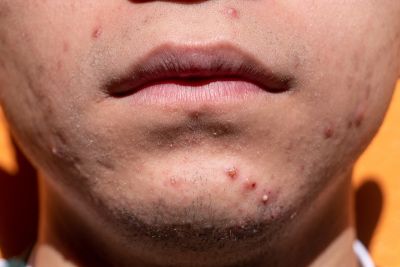 Tratamento para acne é foco de projeto de mestrado em Biotecnologia da UFSCar