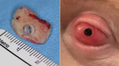 Paciente volta a enxergar após ter dente implantado no olho