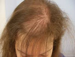 Projeto Clínico – Chamada de mulheres voluntárias para tratamento de alopecia androgenética