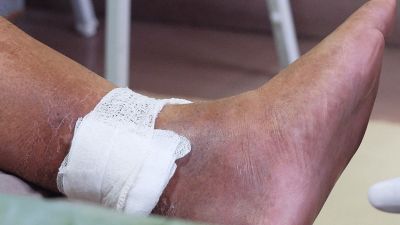 Tratamento inovador visa reduzir amputações de membros inferiores -  Chamada de pacientes